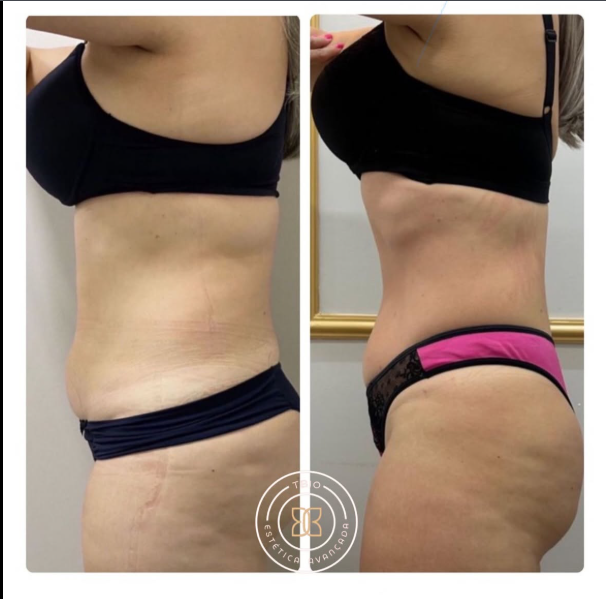 Antes e depois — Corporal TBio