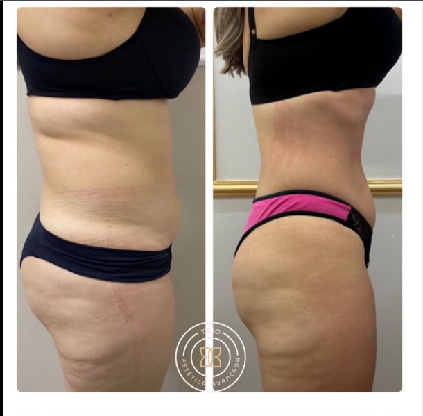 Antes e depois — Medidas TBio