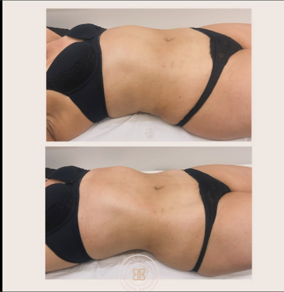 Antes e depois — Definição TBio