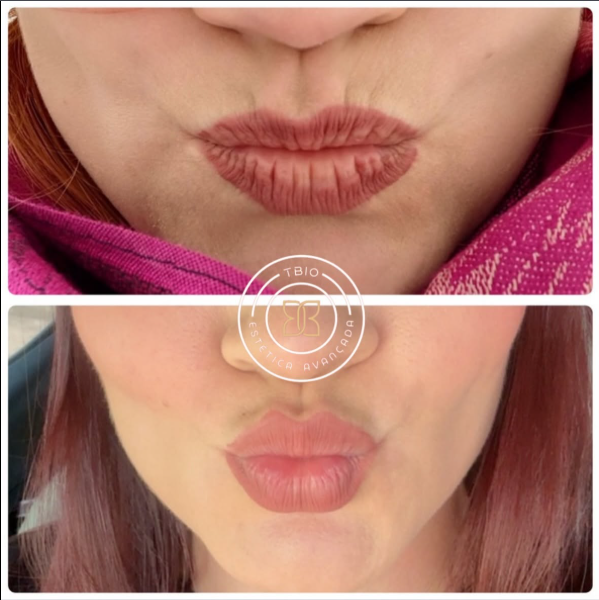 Antes e depois — Lábios TBio