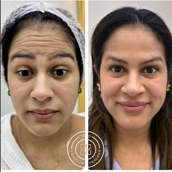 Antes e depois — Harmonização TBio