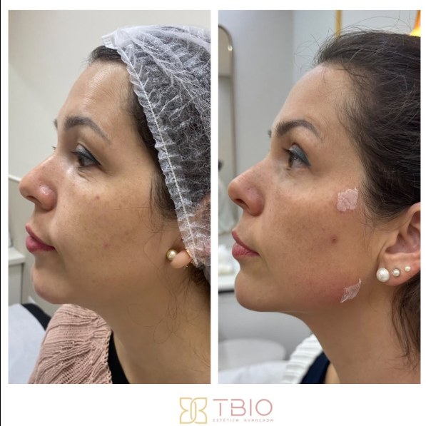 Antes e depois — Skin Quality TBio